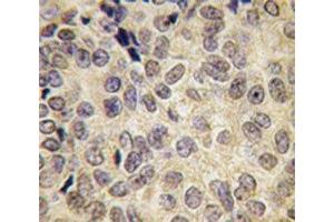 IHC analysis of FFPE human prostate carcinoma tissue stained with Dnmt3b antibody (DNMT3B 抗体  (AA 389-417))