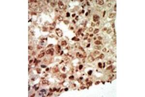 Formalin-fixed and paraffin-embedded human cancer tissue (breast carcinoma) reacted with the primary antibody, which was peroxidase-conjugated to the secondary antibody, followed by AEC staining. (MAPK11 抗体  (Middle Region))