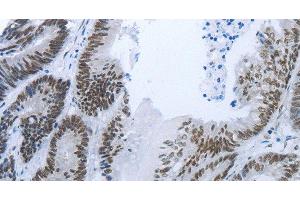 Immunohistochemistry of paraffin-embedded Human colon cancer tissue using RBMS1 Polyclonal Antibody at dilution 1:30 (RBMS1 抗体)