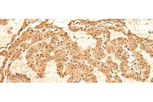 Immunohistochemistry of paraffin-embedded Human thyroid cancer tissue using TIPRL Polyclonal Antibody at dilution of 1:60(x200) (TIPRL 抗体)