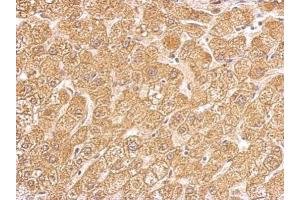 IHC-P Image HSD11B1 antibody detects HSD11B1 protein at cytosol on human hepatoma by immunohistochemical analysis. (HSD11B1 抗体  (C-Term))