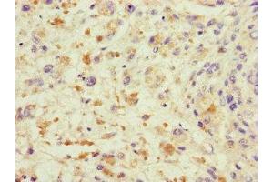 Immunohistochemistry of paraffin-embedded human melanoma using ABIN7172232 at dilution of 1:100 (TRAF2 抗体  (AA 147-281))