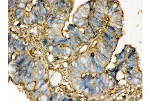 Anti- TGM2 Picoband antibody, IHC(P) IHC(P): Human Intestinal Cancer Tissue (Transglutaminase 2 抗体  (N-Term))