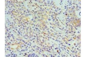 Immunohistochemistry of paraffin-embedded human breast cancer using ABIN7173799 at dilution of 1:100 (TNFSF13 抗体  (AA 105-247))