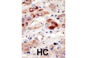 Formalin-fixed and paraffin-embedded human cancer tissue reacted with the primary antibody, which was peroxidase-conjugated to the secondary antibody, followed by DAB staining. (PIK3C3 抗体  (N-Term))