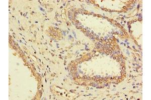 Immunohistochemistry of paraffin-embedded human prostate cancer using ABIN7169312 at dilution of 1:100 (PPP1CC 抗体  (Catalytic Subunit))