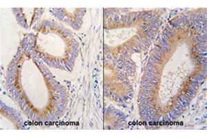 Formalin-fixed and paraffin-embedded human colon carcinoma tissue reacted with GDF11 polyclonal antibody  , which was peroxidase-conjugated to the secondary antibody, followed by DAB staining. (GDF11 抗体  (N-Term))