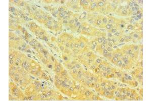 Immunohistochemistry of paraffin-embedded human liver cancer using ABIN7160651 at dilution of 1:100 (MTMR4 抗体  (AA 570-820))