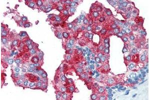 Human Prostate (formalin-fixed, paraffin-embedded) stained with FOLH1 antibody ABIN364431 at 10 ug/ml followed by biotinylated anti-mouse IgG secondary antibody ABIN481714, alkaline phosphatase-streptavidin and chromogen. (PSMA 抗体)