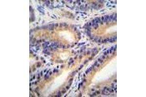 HSD11B1L Antibody : immunohistochemistry analysis in formalin fixed and paraffin embedded human prostate carcinoma followed by peroxidase conjugation of the secondary antibody and DAB staining. (HSD11B1L 抗体  (C-Term))