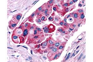 Anti-TRH Receptor / TRHR antibody IHC of human Lung, Non-Small Cell Carcinoma. (TRHR 抗体  (C-Term))
