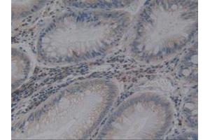 IHC-P analysis of Human Rectum Cancer Tissue, with DAB staining. (Angiotensin I Converting Enzyme 1 抗体  (AA 1160-1306))