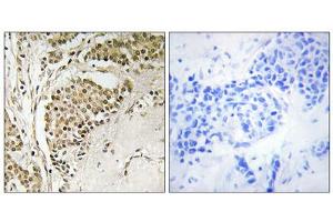 Immunohistochemistry analysis of paraffin-embedded human breast carcinoma tissue using NOM1 antibody. (NOM1 抗体  (C-Term))