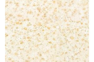 ABIN6264550 and ABIN6277788 at 1/100 staining human astrocytoma by IHC-P.