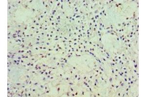 Immunohistochemistry of paraffin-embedded human breast cancer using ABIN7162919 at dilution of 1:100 (Periostin 抗体  (AA 557-836))