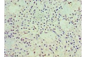 Immunohistochemistry of paraffin-embedded human breast cancer using ABIN7162919 at dilution of 1:100