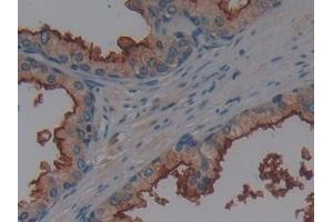 Detection of AAP in Human Prostate Tissue using Polyclonal Antibody to Alanine Aminopeptidase (AAP) (ALT 抗体  (AA 581-738))