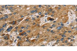 Immunohistochemistry of paraffin-embedded Human liver cancer using SULT1B1 Polyclonal Antibody at dilution of 1:30 (SULT1B1 抗体)