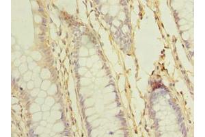Immunohistochemistry of paraffin-embedded human colon cancer using ABIN7168643 at dilution of 1:100
