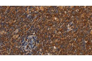 Immunohistochemistry of paraffin-embedded Human Lymphoma using CDC34 Polyclonal Antibody at dilution of 1:50 (CDC34 抗体)