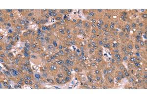 Immunohistochemistry of paraffin-embedded Human liver cancer tissue using GCSAM Polyclonal Antibody at dilution 1:40 (GCET2 抗体)