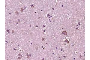 Paraformaldehyde-fixed, paraffin embedded human brain glioma; Antigen retrieval by boiling in sodium citrate buffer (pH6) for 15min; Block endogenous peroxidase by 3% hydrogen peroxide for 30 minutes; Blocking buffer (normal goat serum) at 37°C for 20min; Antibody incubation with YKL39/CHI3L2 Polyclonal Antibody, Unconjugated (bs-1238R) at 1:200 overnight at 4°C, followed by a conjugated secondary and DAB staining. (CHI3L2 抗体  (AA 121-220))