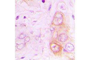 Immunohistochemical analysis of RAB20 staining in human lung cancer formalin fixed paraffin embedded tissue section.