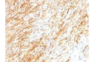 Formalin-fixed, paraffin-embedded human Schwanoma stained with GFAP antibody (GA-5 + ASTRO/789).