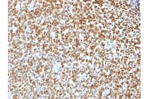 Formalin-fixed, paraffin-embedded human Ewing's Sarcoma stained with NKX2. (Nkx2-2 抗体)
