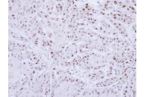 IHC-P Image Immunohistochemical analysis of paraffin-embedded Cal27 Xenograft, using RAD18, antibody at 1:100 dilution. (RAD18 抗体  (Center))