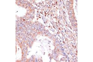 Immunohistochemistry of paraffin-embedded human colon carcinoma using C antibody (ABIN7266010) at dilution of 1:100 (40x lens). (CACNB2 抗体  (AA 481-660))
