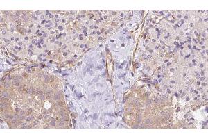 ABIN6273337 at 1/100 staining Human thyroid cancer tissue by IHC-P. (UBE2E2 抗体  (N-Term))