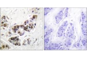 Immunohistochemistry analysis of paraffin-embedded human lung carcinoma tissue, using p53 (Ab-382) Antibody. (p53 抗体  (AA 344-393))