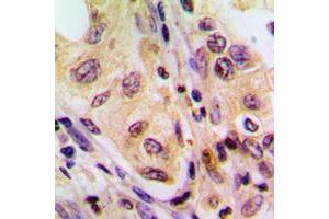 Immunohistochemical analysis of B-RAF staining in human liver cancer formalin fixed paraffin embedded tissue section. (SNRPE 抗体  (Center))