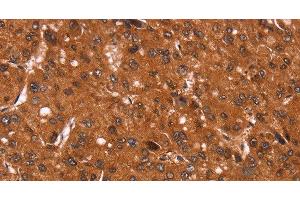Immunohistochemistry of paraffin-embedded Human liver cancer tissue using Cyclin D3 Polyclonal Antibody at dilution 1:40 (Cyclin D3 抗体)