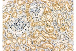 ABIN6261230 and ABIN6277319 at 1/100 staining Human kidney cancer and adjacent normal tissues by IHC-P.