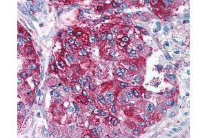 Anti-NPY5R antibody IHC of human Lung, Adenocarcinoma. (NPY5R 抗体  (Cytoplasmic Domain))