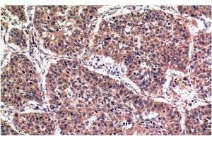 Immunohistochemistry of paraffin-embedded Human lung carcinoma tissue using Phospho-AKT1 (Ser473) Monoclonal Antibody at dilution of 1:200 (AKT1 抗体  (pSer473))