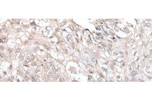 Immunohistochemistry of paraffin-embedded Human lung cancer tissue using VRK3 Polyclonal Antibody at dilution of 1:45(x200) (VRK3 抗体)