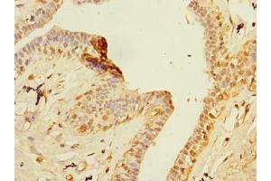 Immunohistochemistry of paraffin-embedded human breast cancer using ABIN7176473 at dilution of 1:100 (ZNF726P1 抗体  (AA 1-389))