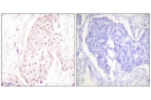 Immunohistochemistry analysis of paraffin-embedded human breast carcinoma tissue using SENP8 antibody. (SENP8 抗体  (C-Term))