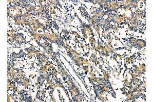 ABIN7095406 and ABIN7099463 at 1/100 staining human colorectal cancer by IHC-P.