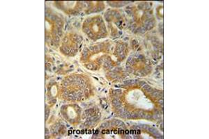 CRABP1 Antibody immunohistochemistry analysis in formalin fixed and paraffin embedded human prostate carcinoma followed by peroxidase conjugation of the secondary antibody and DAB staining. (CRABP1 抗体  (C-Term))