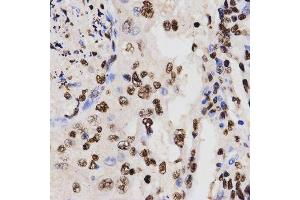 Immunohistochemistry of paraffin-embedded human lung cancer using DiMethyl-Histone H3-K27 antibody. (Histone 3 抗体  (H3K27me))