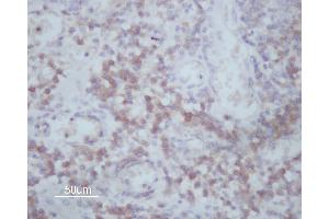 ABIN6266591 at 1/200 staining human Oral squamous cell carcinoma sections by IHC-P. (MMP14 抗体  (C-Term))