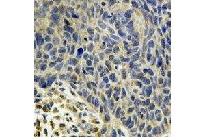 Immunohistochemical analysis of MsrB2 staining in human esophageal cancer formalin fixed paraffin embedded tissue section. (MSRB2 抗体)
