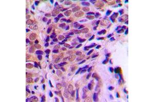 Immunohistochemical analysis of Glucocorticoid Receptor (pS211) staining in human prostate cancer formalin fixed paraffin embedded tissue section. (Glucocorticoid Receptor 抗体  (pSer211))