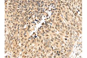 The image on the left is immunohistochemistry of paraffin-embedded Human lung cancer tissue using ABIN7192036(PSMB8 Antibody) at dilution 1/30, on the right is treated with synthetic peptide. (PSMB8 抗体)