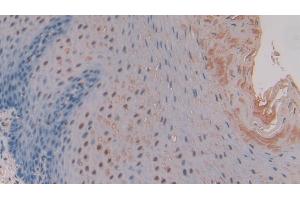 Detection of MMP11 in Human Esophagus cancer Tissue using Polyclonal Antibody to Matrix Metalloproteinase 11 (MMP11)
