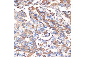 Immunohistochemistry of paraffin-embedded human lung cancer using VPS28 Rabbit mAb (ABIN7271275) at dilution of 1:100 (40x lens). (VPS28 抗体)